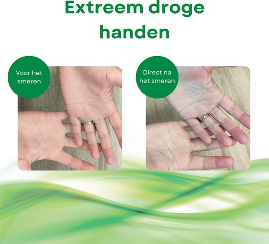 ALHYDRAN Cracked Dry Skin Care – Medische crème voor droge of gebarsten huid