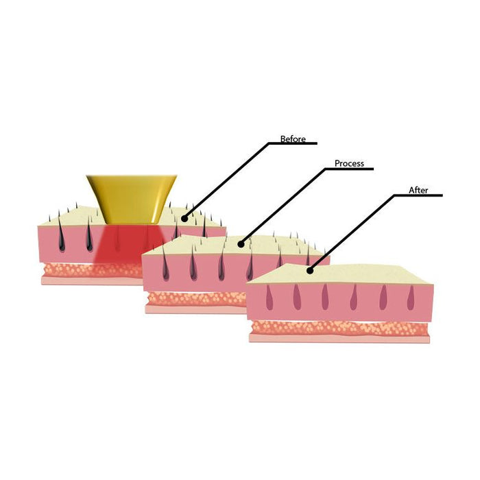 PORTABLE QUATTRO-PRO® DIODE ICE LASER